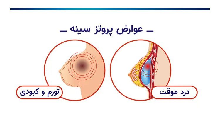 عوارض پروتز سینه چیست؟