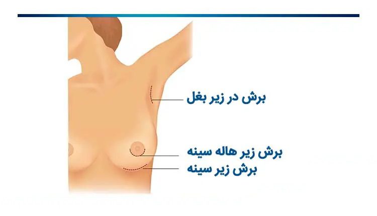 مراحل عمل زیبایی سینه