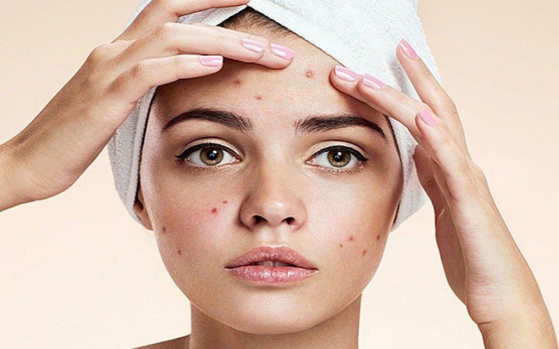 جوش هایی که نباید بترکانیم را چگونه از بین ببریم؟