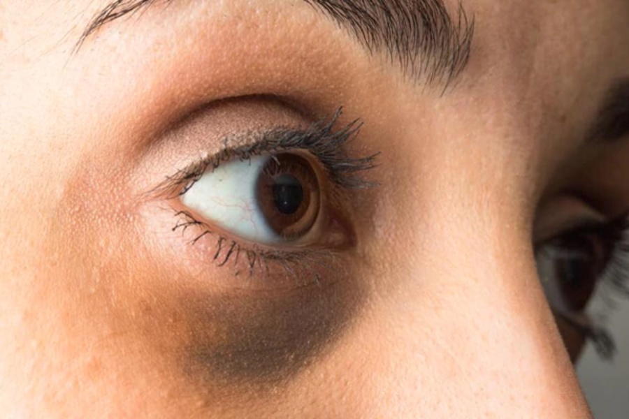 بهترین و جدیدترین روش های درمان سیاهی دور چشم 