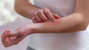 علائم شایع و نشانه‌های بیماری‌های پوستی در زنان