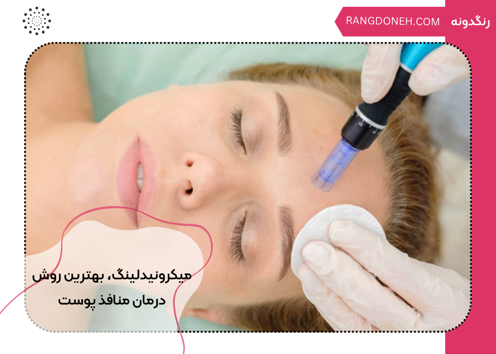 میکرونیدلینگ، بهترین روش درمان منافذ پوست